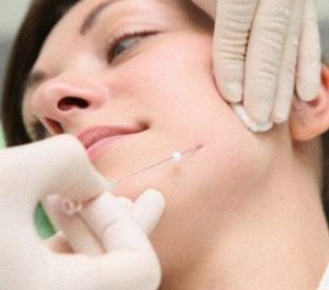ترد لیفت پوست صورت با نخ ليفتينگ قابل جذب کاگ با جنس pdo (پلي دي اکسانون) و نخ اسکرو، جديدترين روش غير تهاجمي مورد استفاده در درمان کشيدن پوست و ايجاد فرم وي (V) شکل به صورت مي باشد.